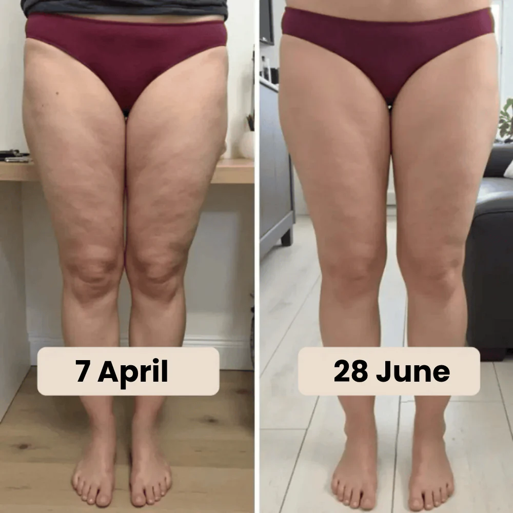 Cellumove 3D Legging – Say goodbye to lipoedema pain and swelling naturally - Image 7